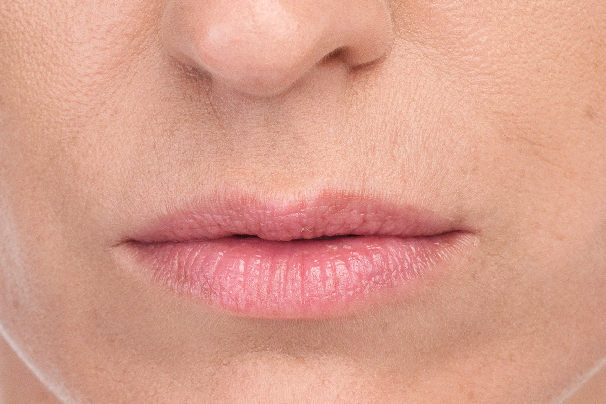 woman's lips after dermal fillers in Arlington and Olive Branch