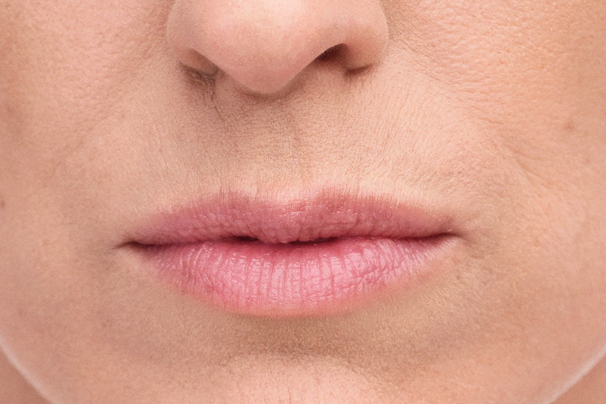 woman's lips before dermal fillers in Arlington and Olive Branch